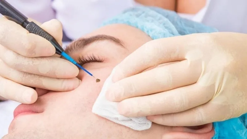 Giai đoạn vết thương còn hở và đóng mài là thời điểm cần kiêng kỹ nhất để hạn chế thâm sẹo.