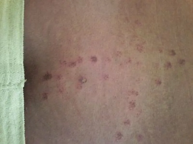 Dùng thiết bị sai mức năng lượng có thể làm tăng nguy cơ bỏng nhẹ hoặc thâm da