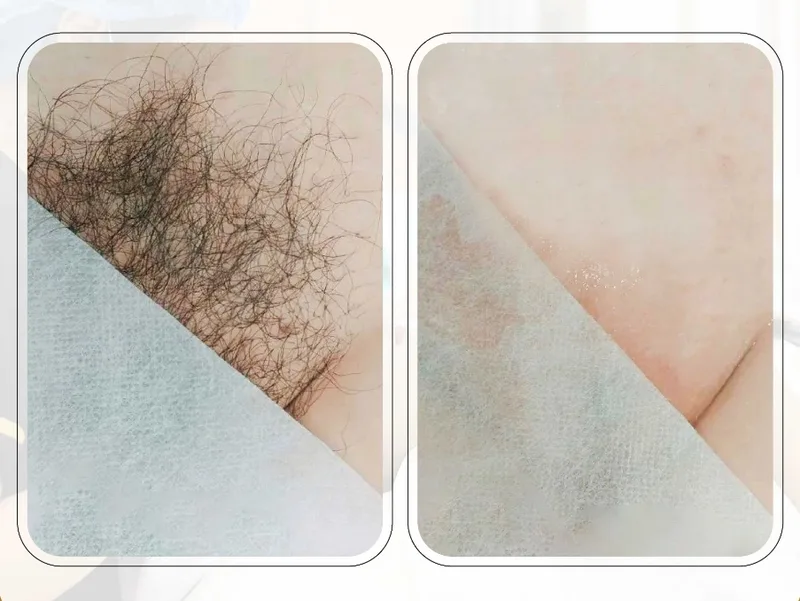 Người thường xuyên mặc đồ bơi hoặc thấy bí bách có thể cân nhắc triệt lông bikini